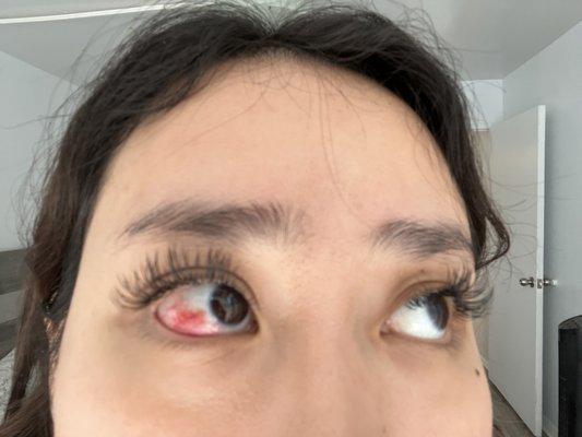 Blood vessel popped in eye