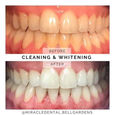 In-office teeth whitening