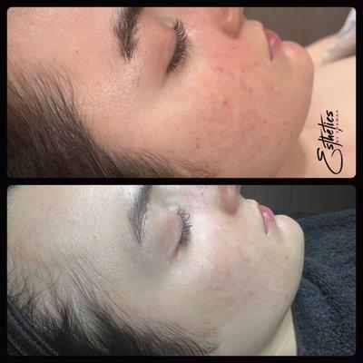 Before + After Procell Microchanneling  3 session  Great for Acne scars , tightening , skin tone , pigment brightening and more