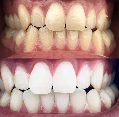 Whiten 7-10 shades in one session!