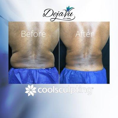 CoolSculpting Before And After