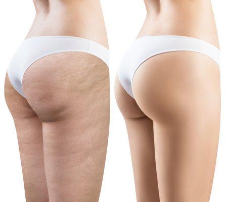 Cellulite Reduction