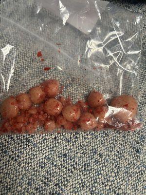 Bladder stones