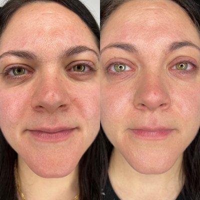 Fibroblast eyelids & under eyes