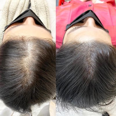 Scalp micropigmentation