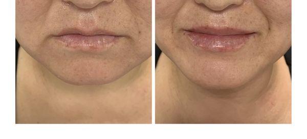 Lips Filler