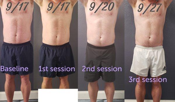 Cavitation (fat reduction) - male client 3 sessions