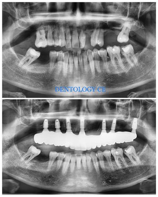 All upper teeth replacement with dental implants