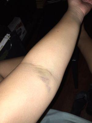 Bruise on arm spreading... for a single blood draw.