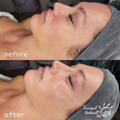 "The Cadillac Facial" A 90 min Oxy-Hydroluxx & Dermaplane Combination!