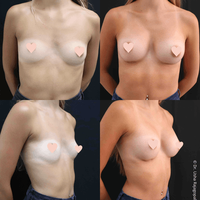 Breast augmentation by Dr. Usha Rajagopal in San Francisco