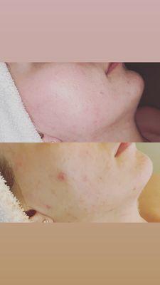 Acne facial