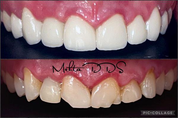 Cosmetic Veneers/Crowns