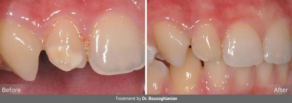 Cover unsightly spots on teeth with gorgeous results!