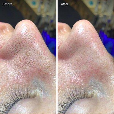 HYDRAFACIAL RESULTS