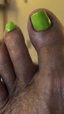 Bleeding cuticles around toenails & swollen