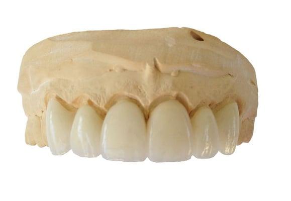 Porcelain Jacket Crowns by Lawrence Dental Lab