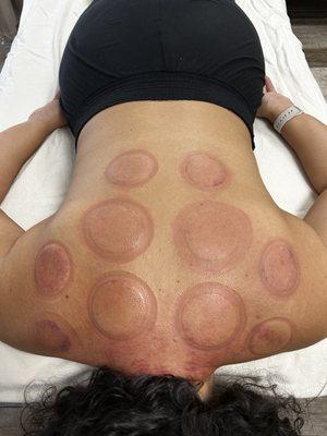 FIre Cupping