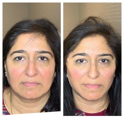 PDO thread facelift, 90 minute transformation.