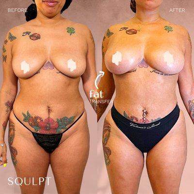 Fat Transfer to Breasts (875 cc/right, 775 cc/left) + SoftSqulpt™ awake lipo to abdomen, waist & hips, lower back, back bra roll