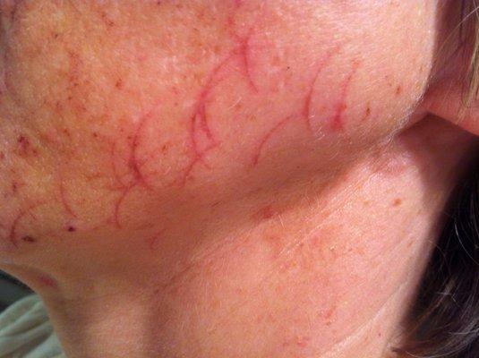 Laser treatment burns-had on both sides of my face.