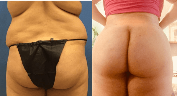 Liposuction before and after