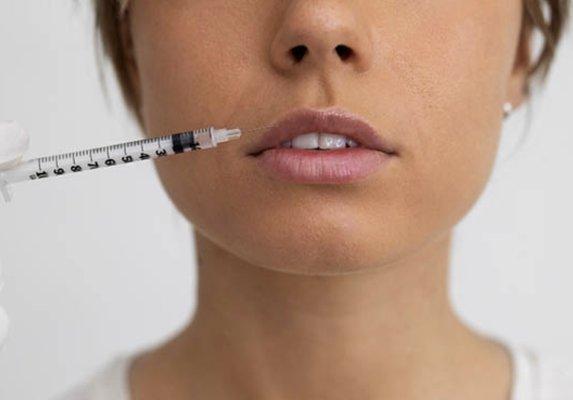 Cosmetic procedures - Lip fillers