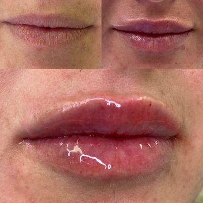 before and after lip filler for that kissable pout