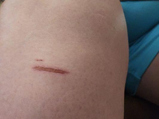 Rope burn from retractable leash on right leg