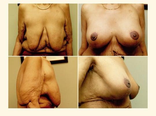 Breast lift before and after