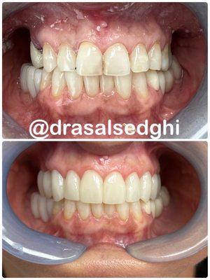 Before/After (natural shade per patient request)