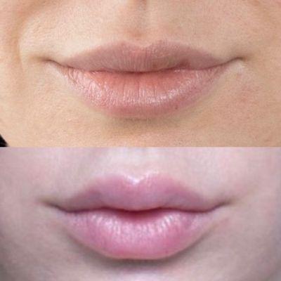 Full face fibroblast before and after (lip flip)