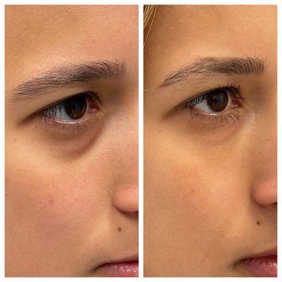 Under Eye Bags- Tear Trough Filler