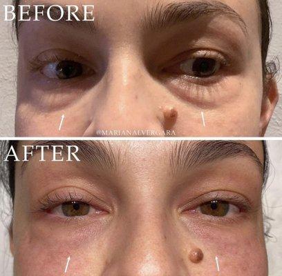 Under Eye Fillers