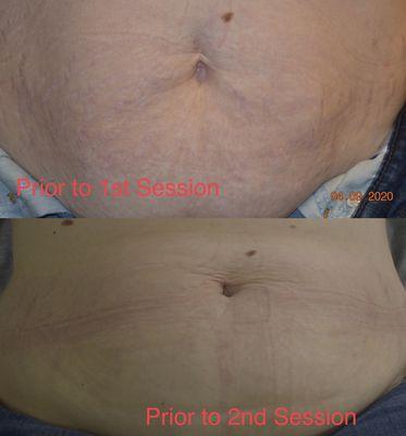 Faded Stretch Marks utilizing PRP