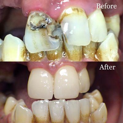 Patient is happy with the results of the two crowns placed and is continuing treatment.