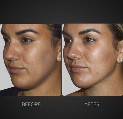 No cheek fillers.  BussoLyft lifts the patient's own fat to improve cheek definition and fullness, while creating a more defined jawline.