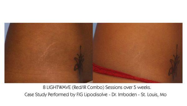 Reduction in stretch marks with LED therapy.