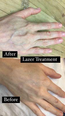 Laser treatment on hands just one treatment great results