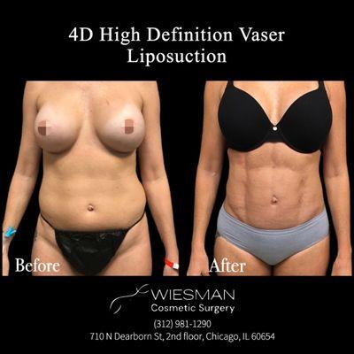 4D High Definition Vaser Liposuction by Dr.Irvin Wiesman. Please call (312) 981-1290 to schedule your consultation!