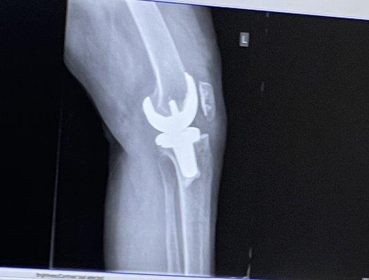 Knee replacement