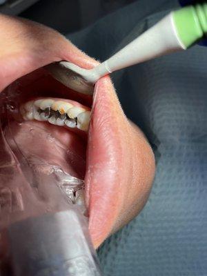 Before Onlays, patient came in with amalgam fillings.