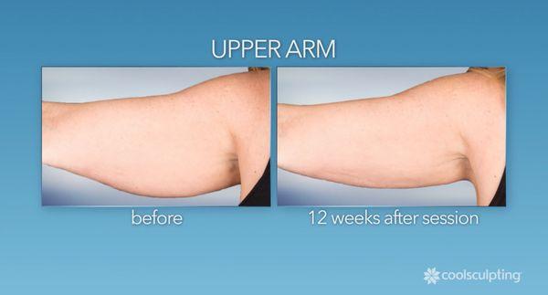 Arm coolsculpting