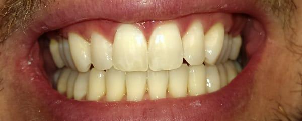 Zoom Whitening 'After' photo. Presidio Dental San Francisco. karamyandental.com