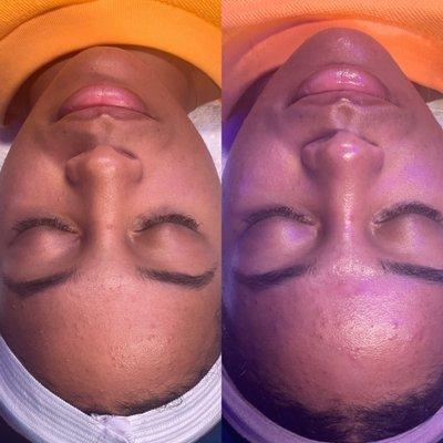 Before and after 1st "blemish be gone" acne facial