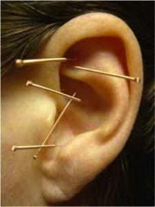 Ear acupuncture, great for addiction recovery!