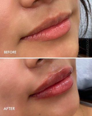 1 syringe of Restylane Kysse filler in the lips