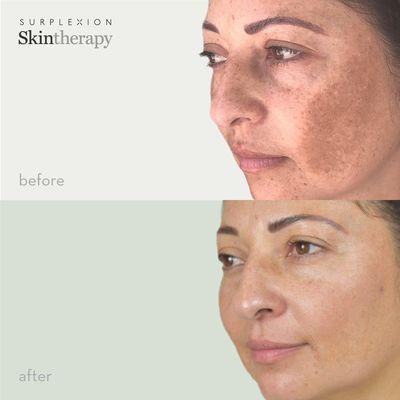 Before and After - customized treatment! Results after two treatments!