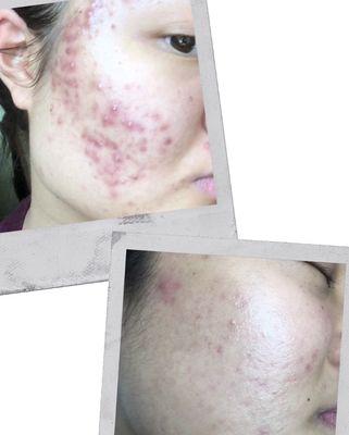 Before and After Acne Treatment preformed after 2 treatments