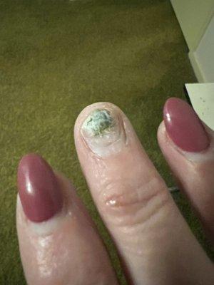 Fungus/mold under "glueing" the nail after it lifted. Horrible.